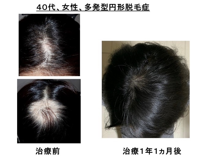 汎発性脱毛　病院